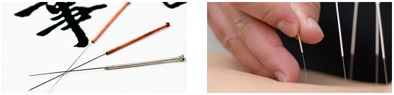 How Does Acupuncture Work