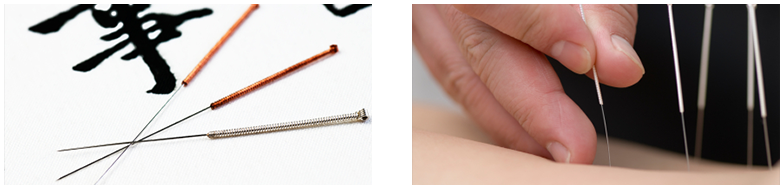 How Does Acupuncture Work