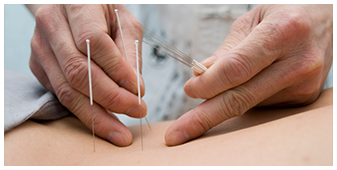 Acupuncture