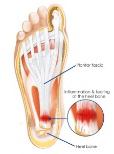 plantar-fascia